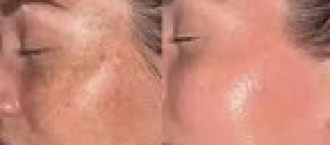 Mikroneedling im Gesicht